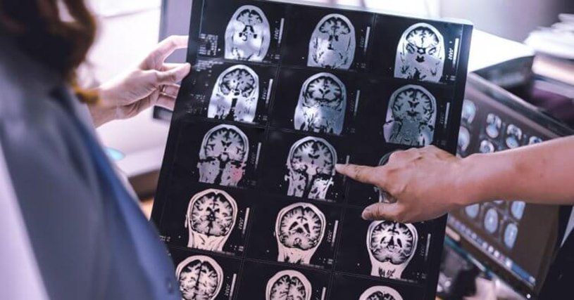 MRI scan of a brain with dementia